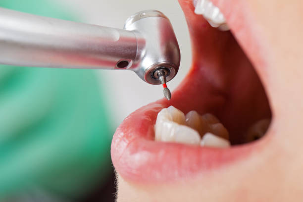 Best Emergency Wisdom Teeth Removal in Durant, IA